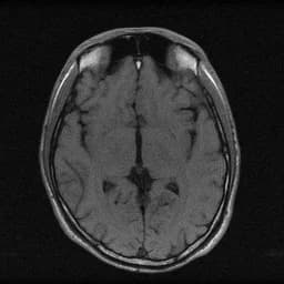 AI Enhanced MRI