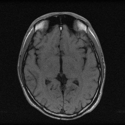 AI Enhanced MRI